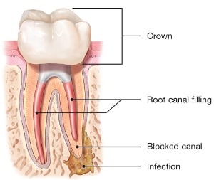 endodontic-retreatment-root-canal